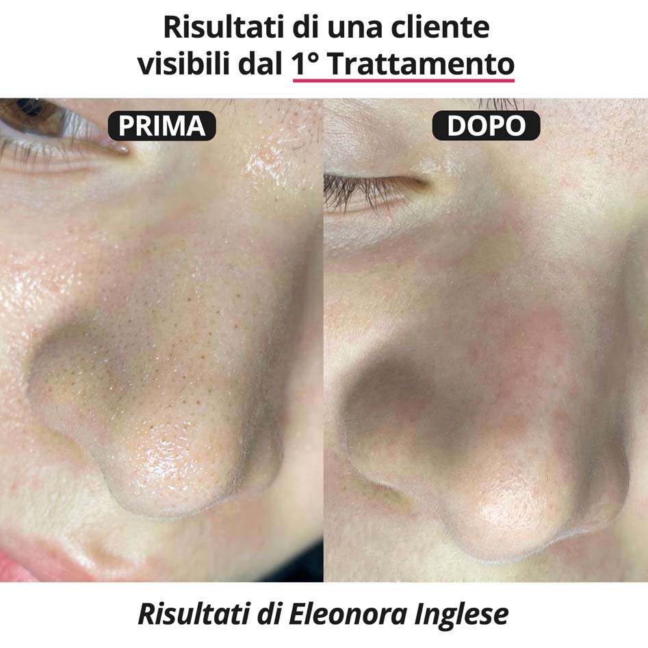 2x Blackheads Treatment Kit