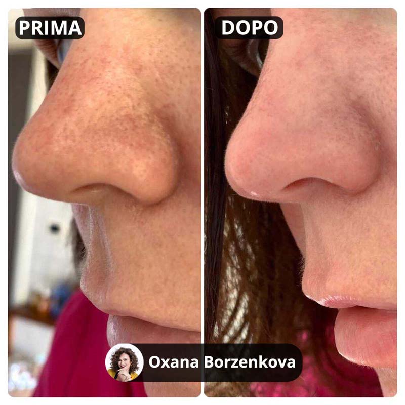 2x Blackheads Treatment Kit